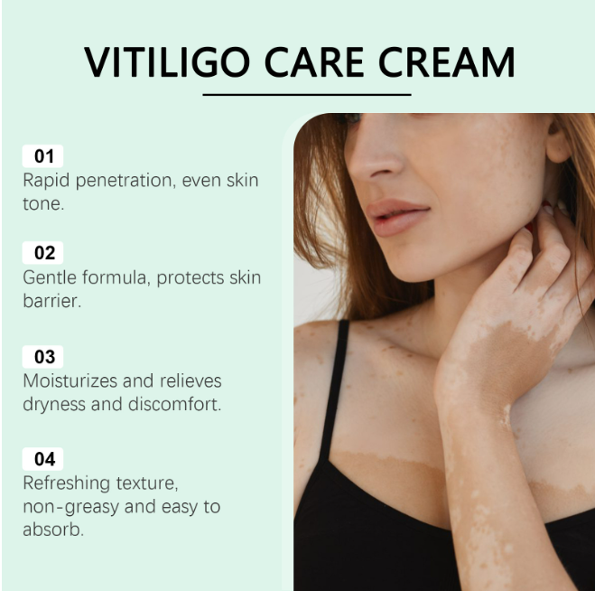 🎁Buy 2 Get 1 free——NEGUSY™ Botanical Vitiligo Repair Cream (Stop Hiding Protocol) 🌿